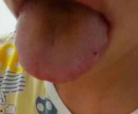 嗓子发炎吃瓜吗,吃瓜还是喝水？探寻嗓子不适时的饮食选择